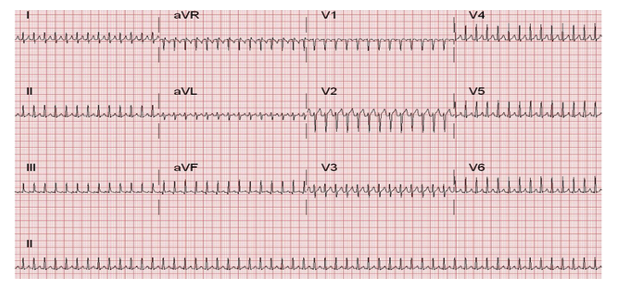 ECG Rhythm showing typical SVT